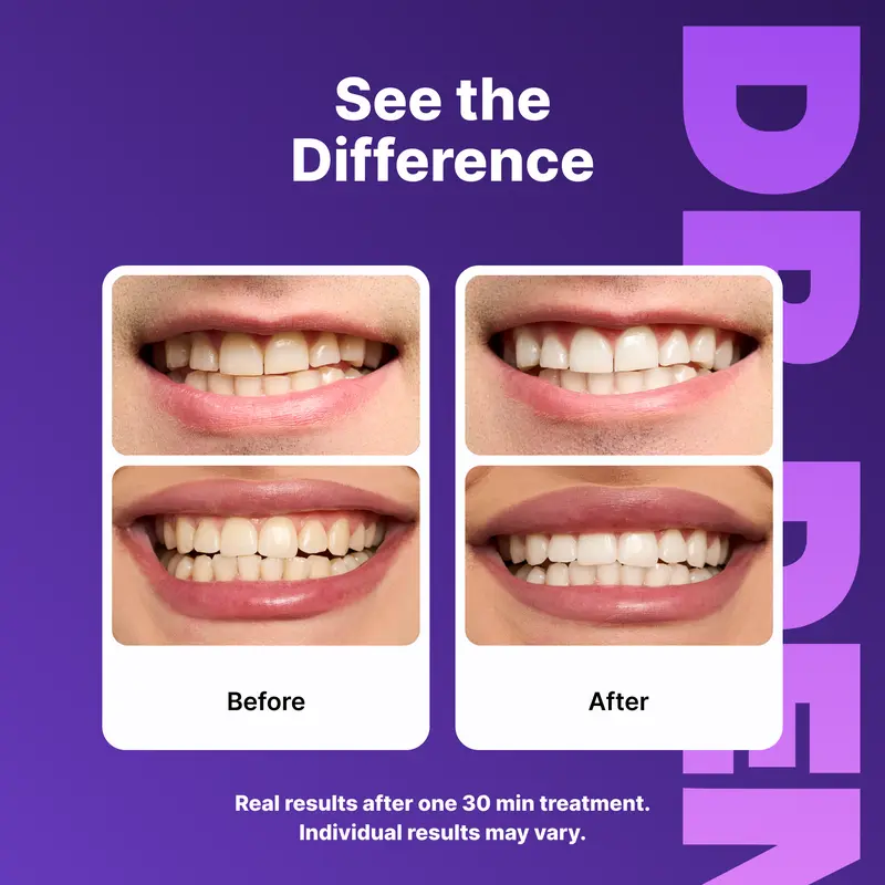Purple Teeth Whitening Strips: Brighten Teeth & Remove Stains Safely