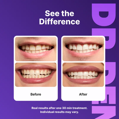 Purple Teeth Whitening Strips: Brighten Teeth & Remove Stains Safely