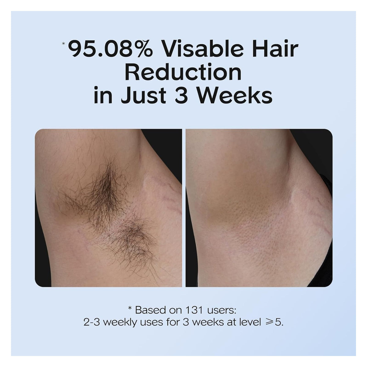 INNZA IPL Hair Removal with Ice Cooling Care Function for Women and men — source gallery photo
